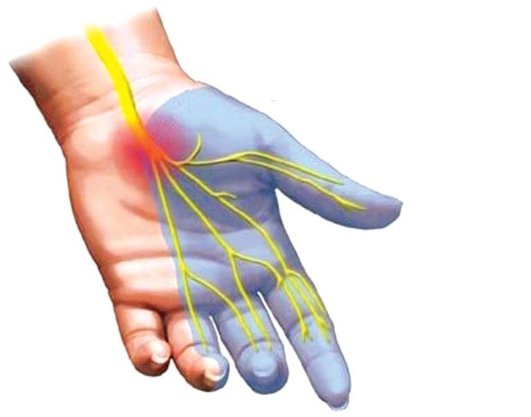 Entumecimiento de la mano con osteocondrosis. 