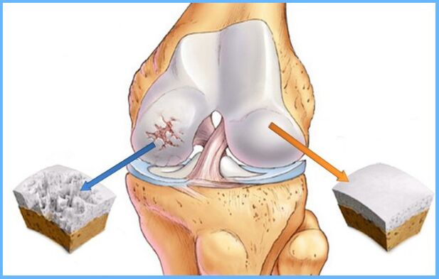 Artrosis de la articulación de la rodilla