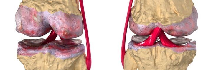 Articulación sana y osteoartritis de la articulación de la rodilla