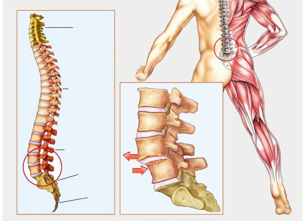 columna sana y enferma