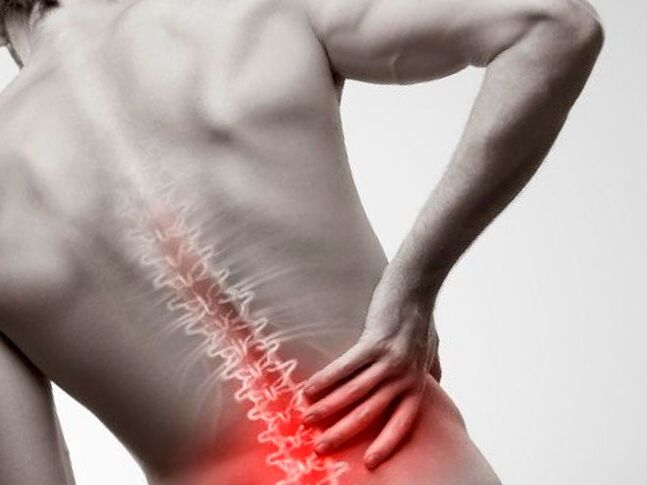 Dolor lumbar debido a la osteocondrosis.