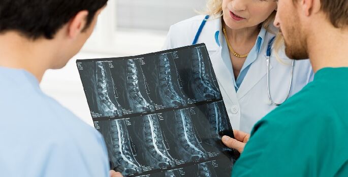 Radiografía de la columna que se utiliza para diagnosticar la osteocondrosis. 