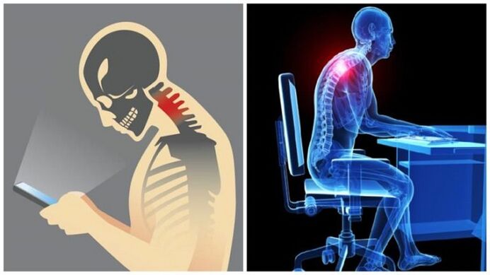 Trabajo sedentario y encorvamiento como causas del desarrollo de osteocondrosis. 