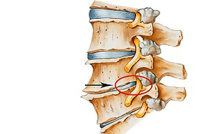 Disco intervertebral pinzado en la columna como causa de osteocondrosis cervical