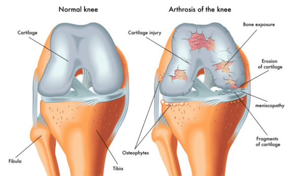 Articulación normal e influenciada por la osteoartritis